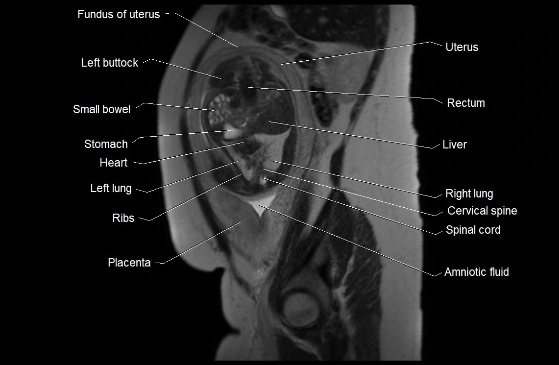 MRI fetal anatomy sagittal image 9.webp